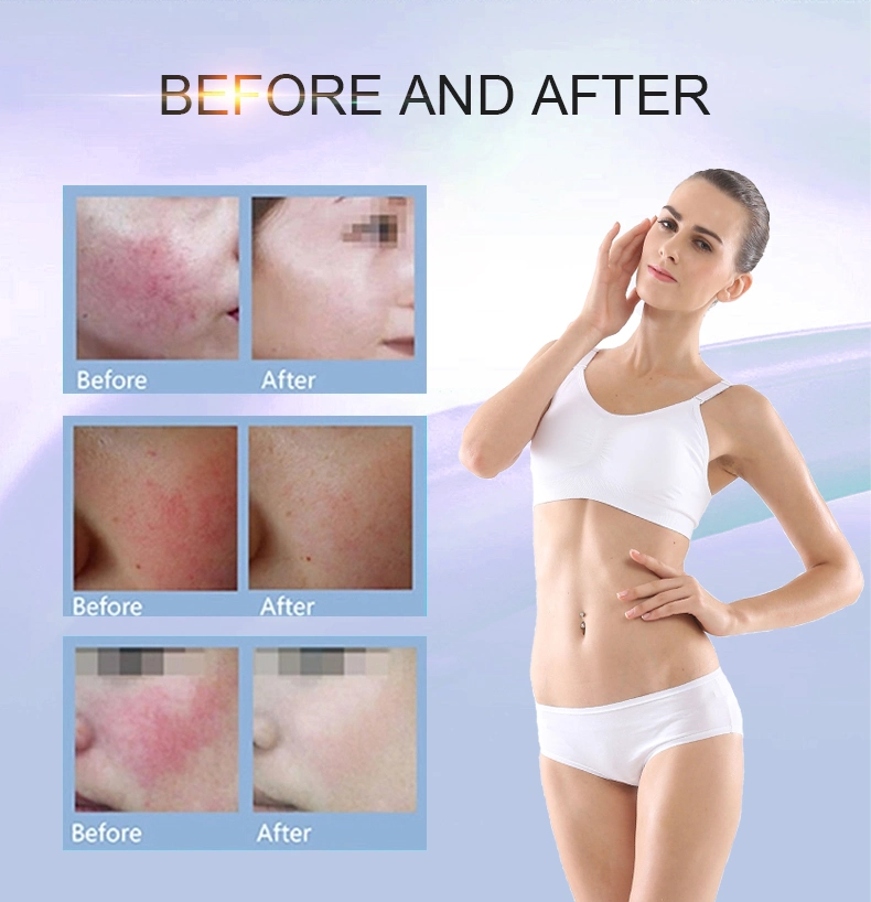 Multifunctional High Power 980nm Diode Laser Vein Removal Vascular for Sale