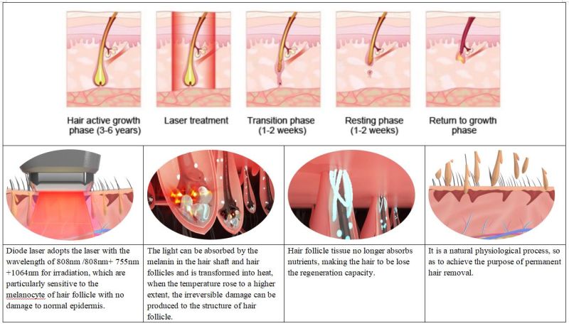 808nm Permanent Hair Removal Diode Laser Beauty Device/ Machine