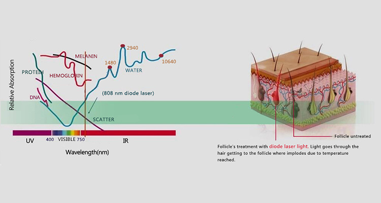 2021 Best Sale 808+755+1064+940nm Diode Laser Hair Removal