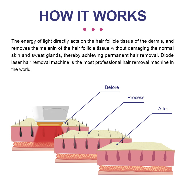 Laser Hair Removal Machine Price in Europe Diode Laser 808 Permanent Hair Removal