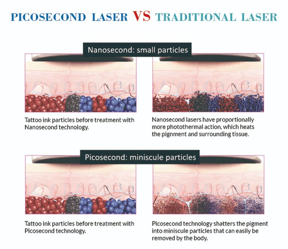 Korea Spot Removal 1064nm/532nm/755nm Picosecond ND YAG Laser Price Equipment