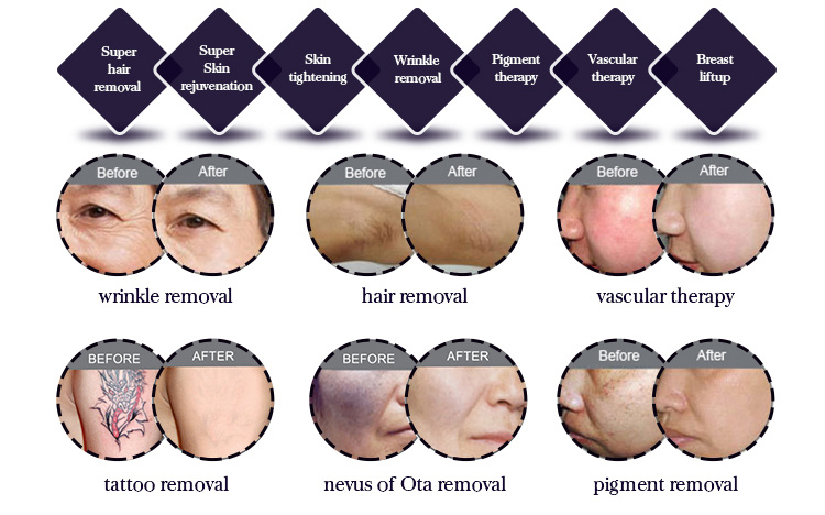 Hotest Shr Depilation Elight IPL+RF+E-Light+ND YAG Laser