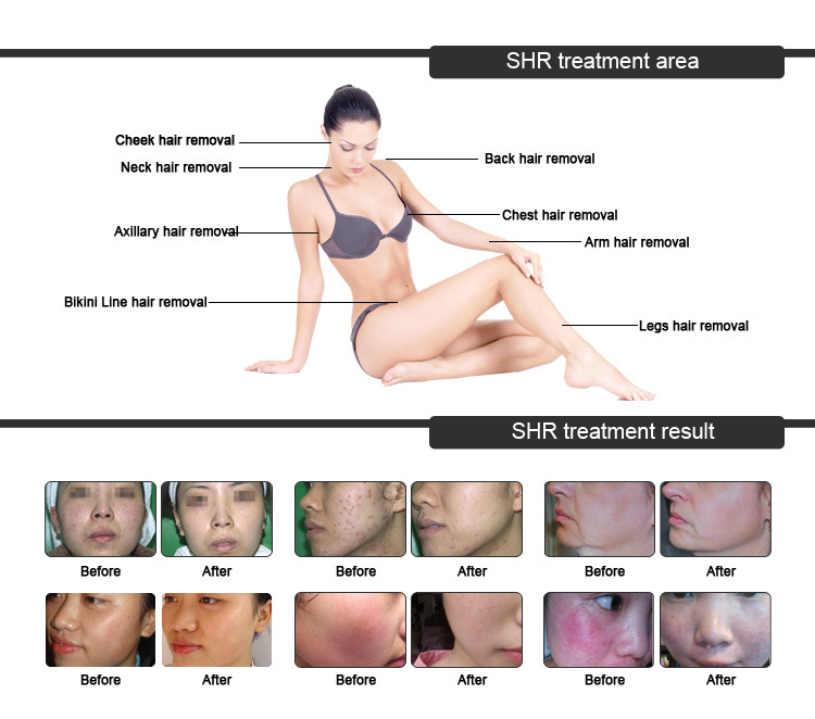 Big Discount IPL +Shr Hair Removal Machine / Portable Shr IPL Laser