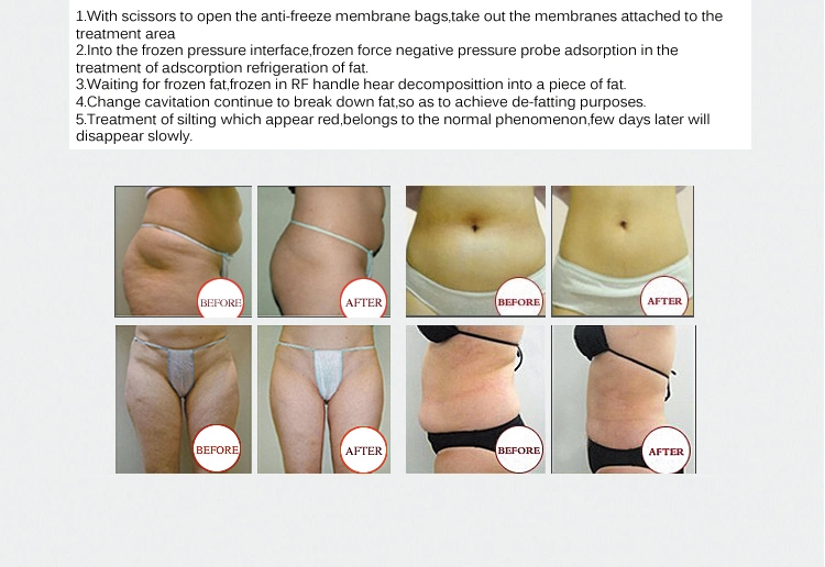 Multiple Weight Loss Machine Double Cryolipolysis RF Cavitation Slimming Machine