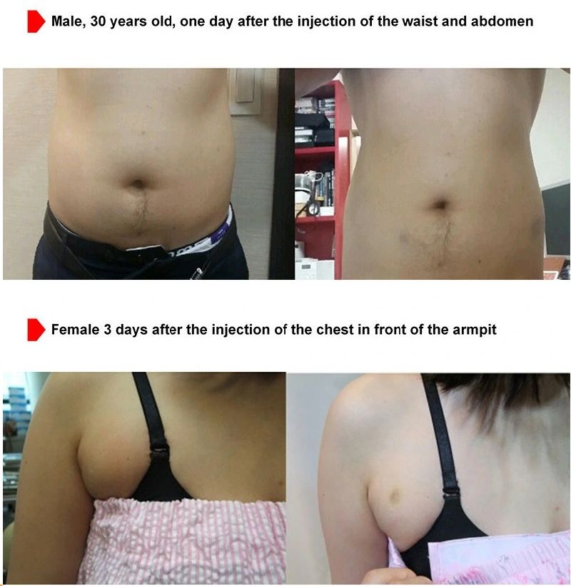 General The Red Ampoule Solution Korea Dissolve Fat Injection Lipolysis