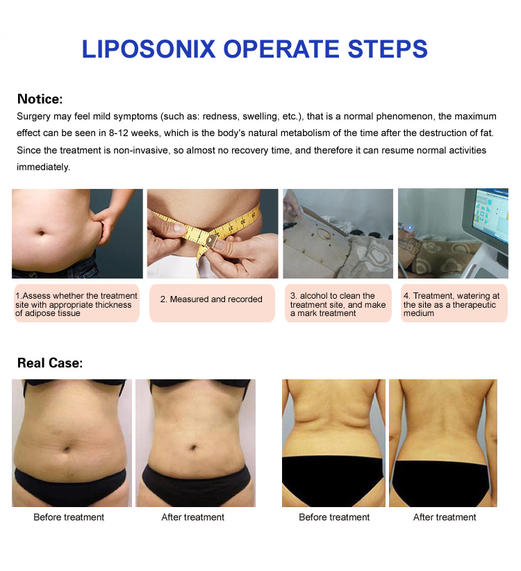 Slimming Body Machine Body Slimming Machine Liposonix Hifu Cartridge