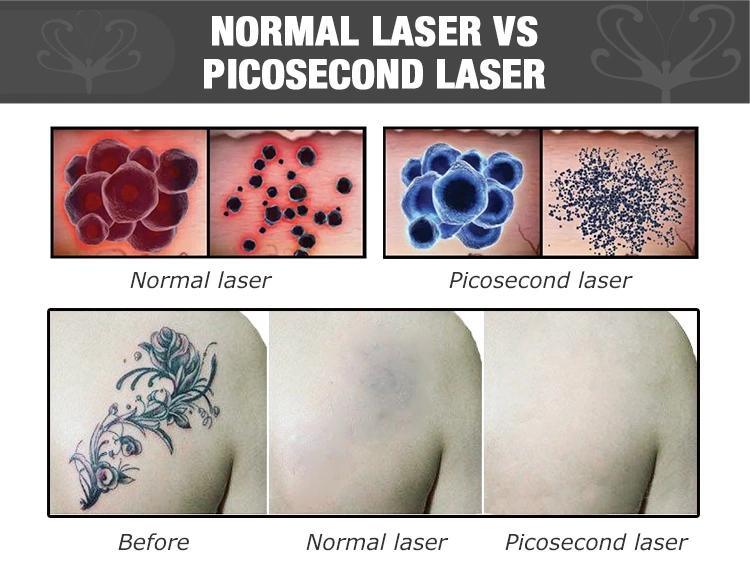 High Quality Picosecond Laser ND YAG Laser Tattoo Removal Beauty Machine
