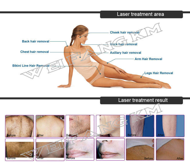 Tan Skin Hair Removal 808nm Diode Laser Depilacion Laser