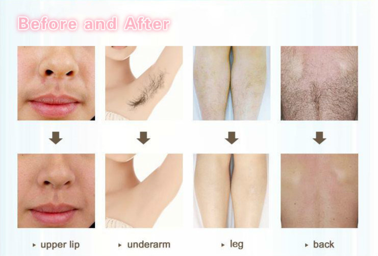 Painless 755 808 1064 Portable Diode Laser Hair Removal Machine