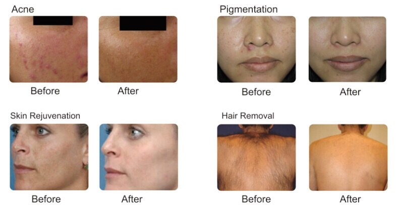 IPL Hair Removal Machine IPL Photo Rejuvenation Pigment Removal IPL Shr