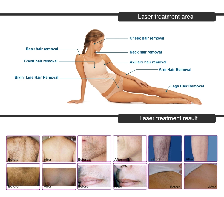 FDA Medical Ce Approved Permanent Alexandrite Laser 808nm Diode Laser Hair Removal