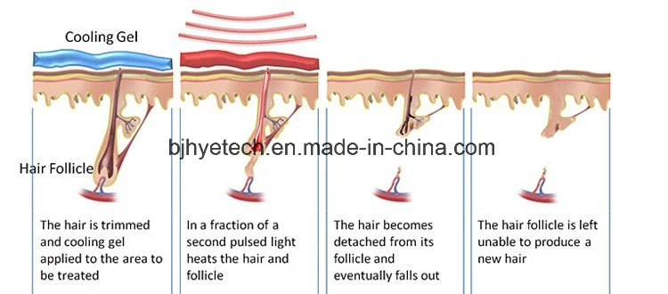 Macchina per la rimozione dei capelli laser a diodo 808nm indolore e permenante