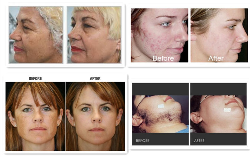 Beauty Salon Medical Equipment IPL Shr Hair Removal and Skin Rejuvenation