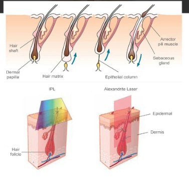 High Quality Alexandrite Laser 755nm+1064nm Long Pulse Laser Best Laser Hair Removal Machine