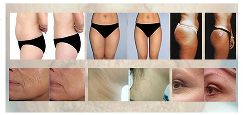 Cavitation RF Vacuum Roller Laser Slimming Machine with Ce FDA