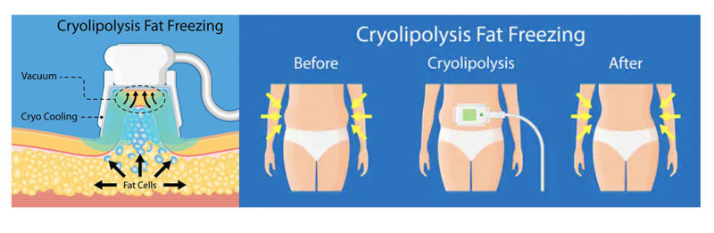 7 Handles Anti-Cellulite Cryolipolysis Machine Cryolipolysis Slimming Machine