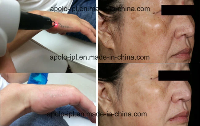 Apolomed Tattoo Removal ND YAG Laser and IPL Shr RF Multifunction Laser Machine