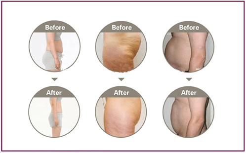 Cryolipolysis+RF+Cavitation +Lipo Laser Slimming Machine