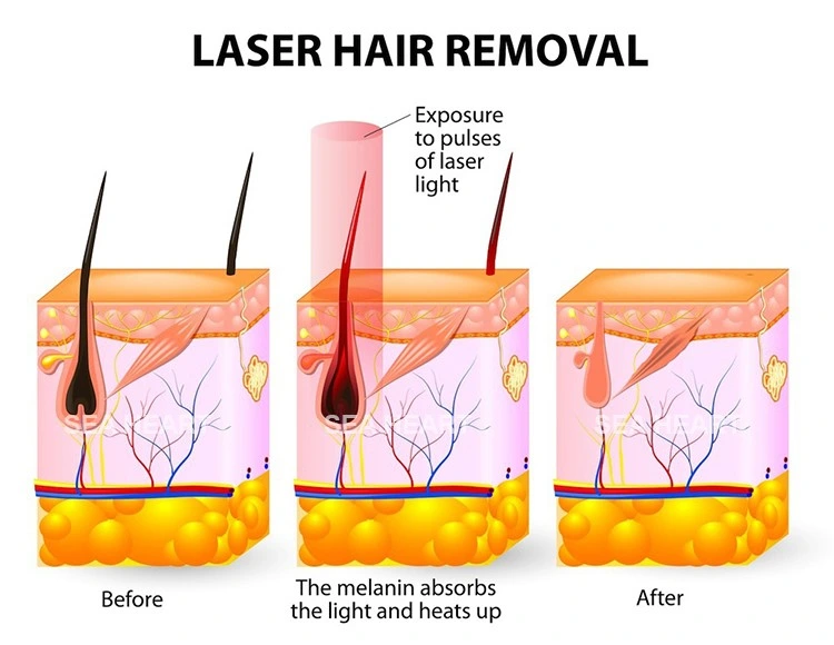 Professional 600W 755/810/1064nm Diode Laser Hair Removal