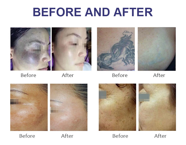 Effective Treatment Picosecond Laser ND YAG Laser Tattoo Removal Skin Rejuvenation ND YAG Machine