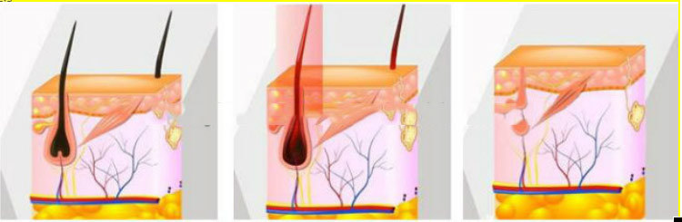 2021 Hot Sale 5 in 1 E-Light Shr IPL ND YAG Laser Hair Removal Multifunction Beauty Machine