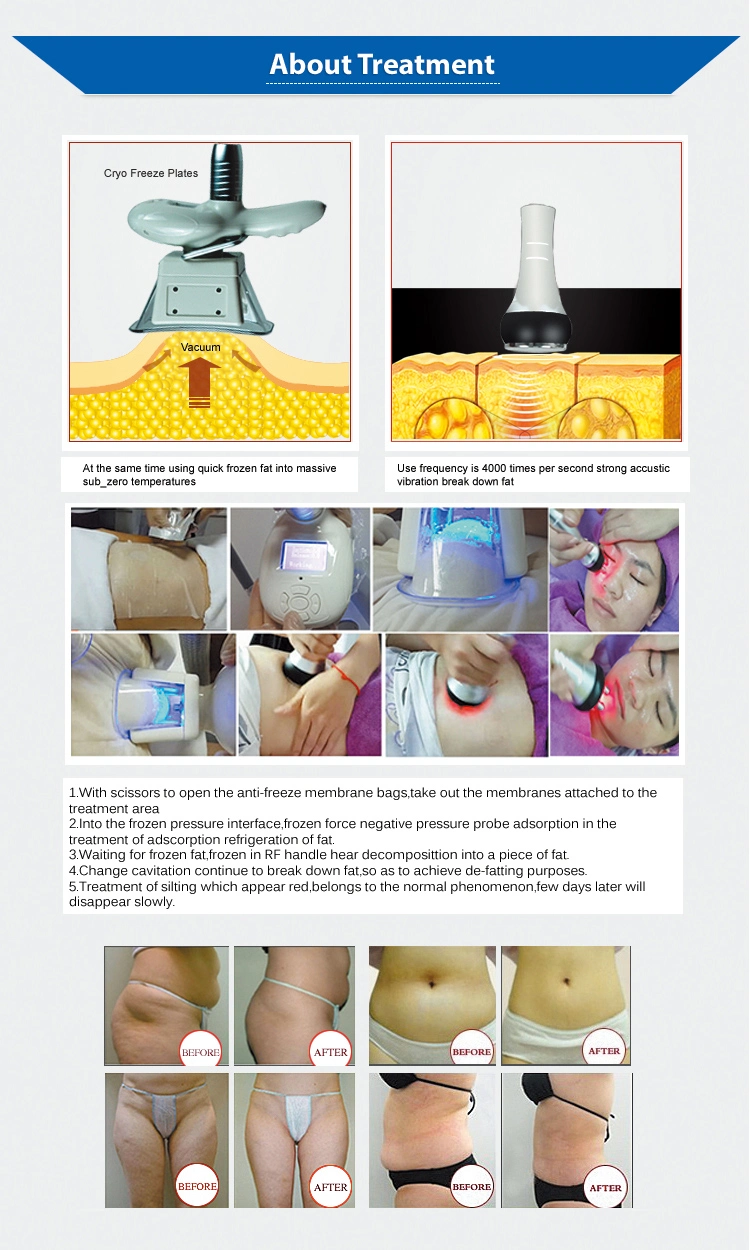 Multipolar RF Cryolipolysis System Fat Freeze Slimming Machine for Sale