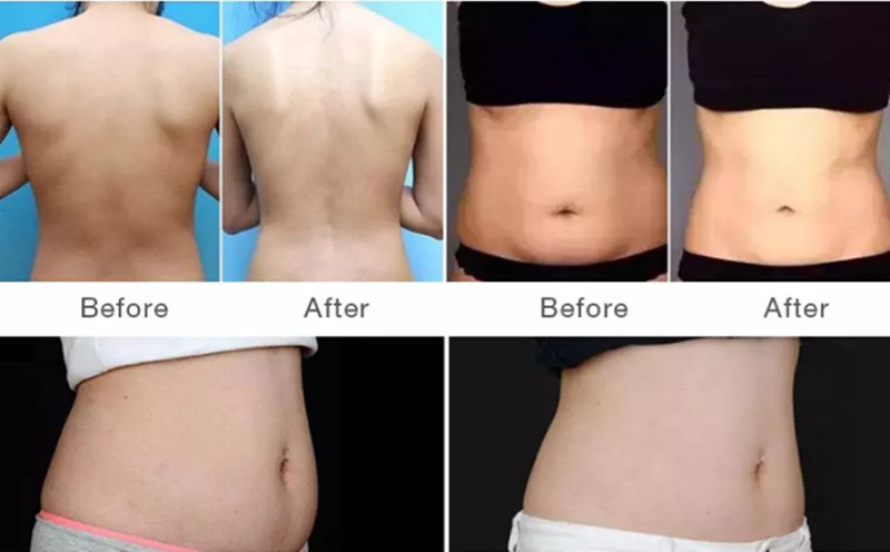 RF Cavitation Cryolipolysis Slimming Machine for Weight Loss