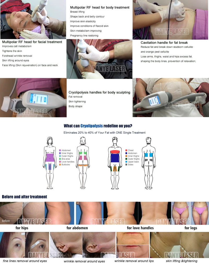 360 Freeze Cryo Cavitation RF Slimming Machine