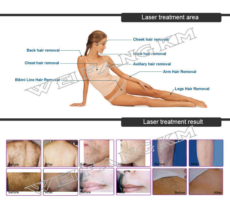 Professional Elight Hair Removal 808nm Diode Laser Epilation