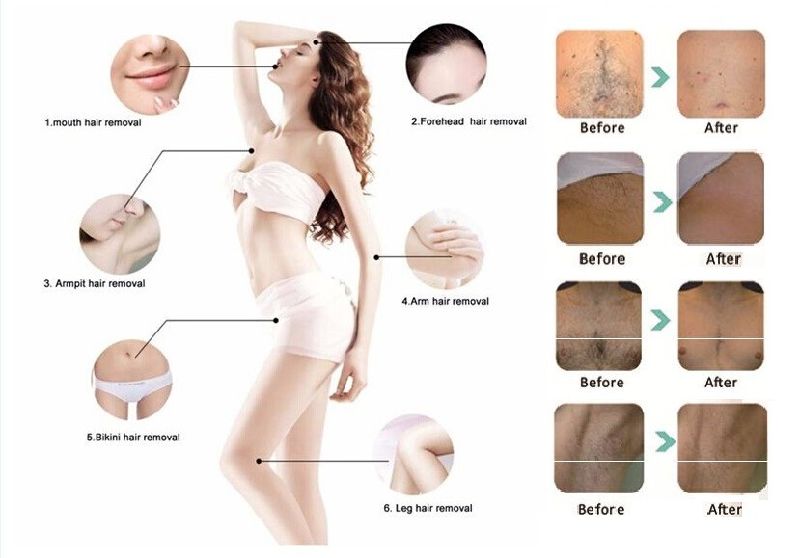 Popular Powerful Germany Bars 808nm Diode Laser for Hair Removal