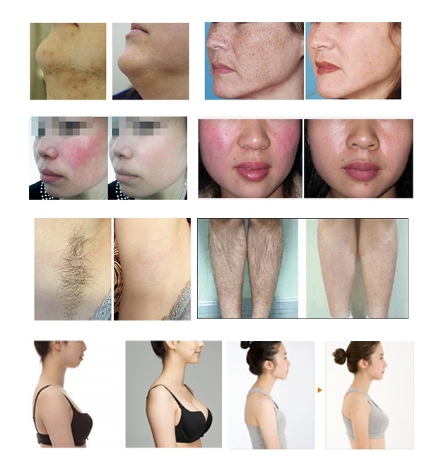 Hotest Shr Depilation Elight IPL+RF+E-Light+ND YAG Laser