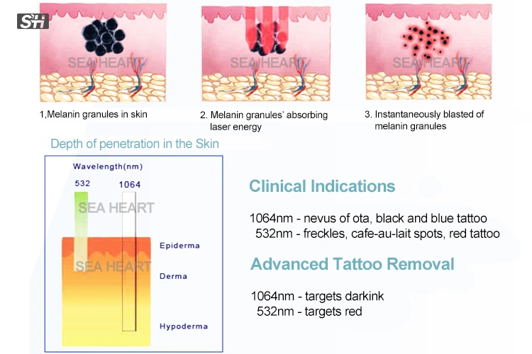 Picosecond Q Switch ND: YAG Laser for Tattoo Removal, Age Pigment & Freckle Removal