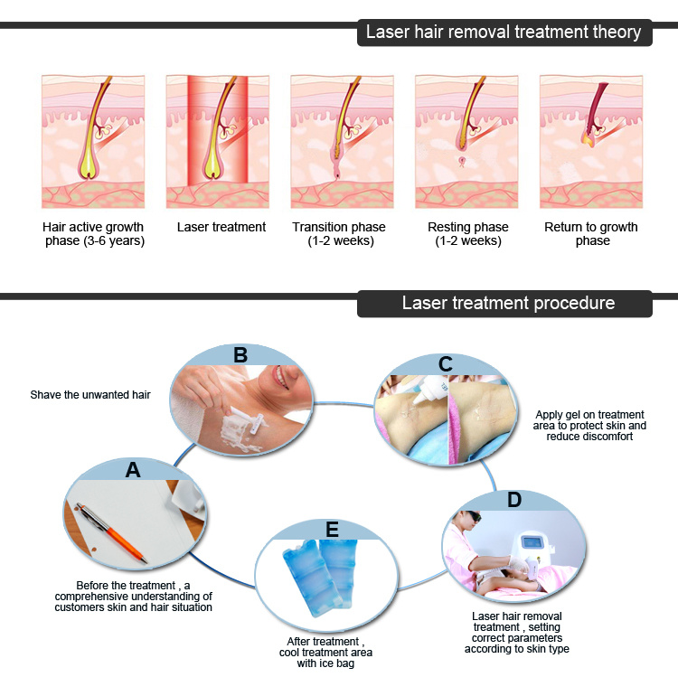Lightsheer Laser Deplication 808nm Diode Laser for Permanent Hair Removal