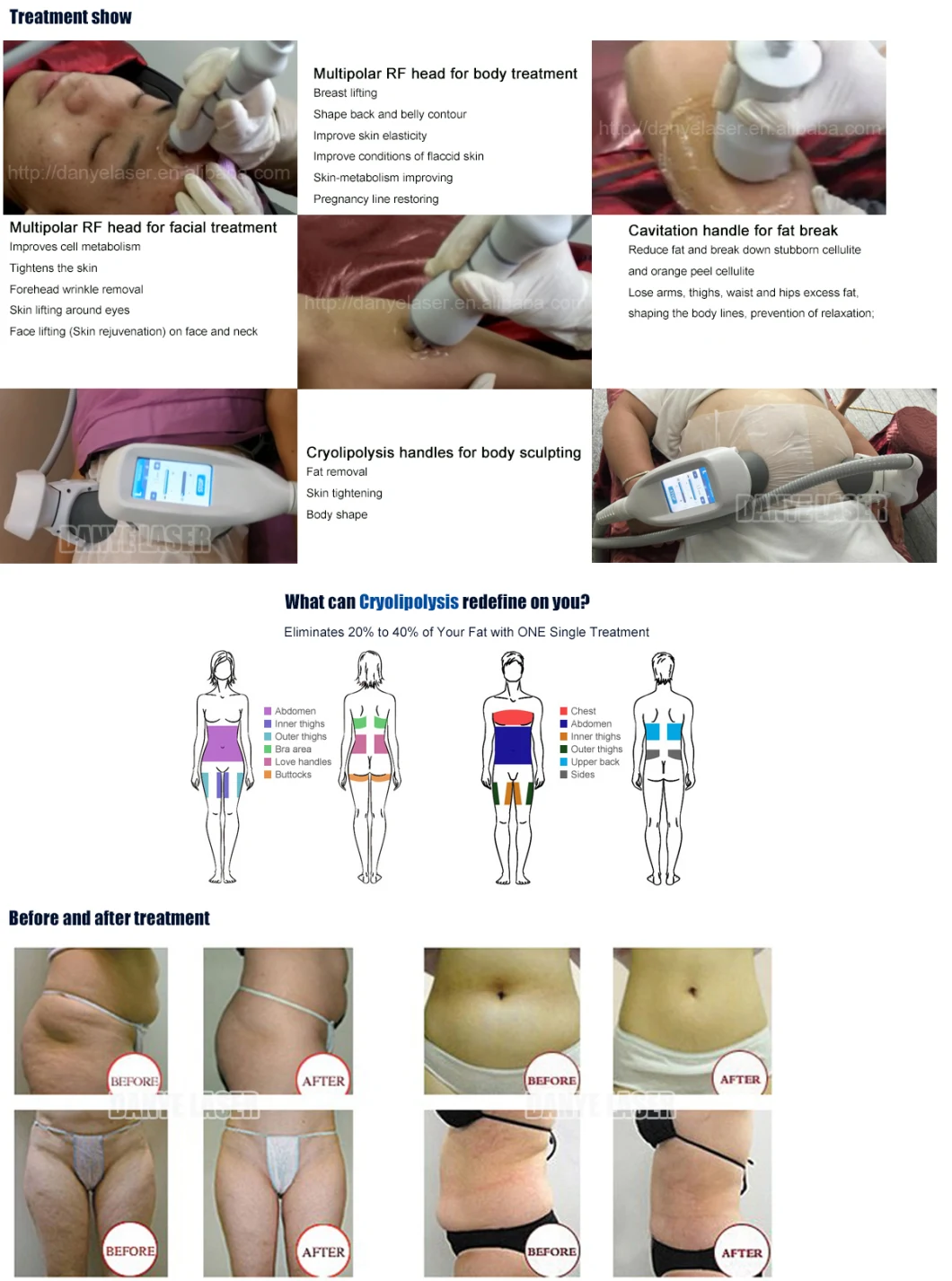 360 Cryotherapy Fat Loss Body Shaping Equipment Lipolaser Cavitation RF Cryo Slimming Machine