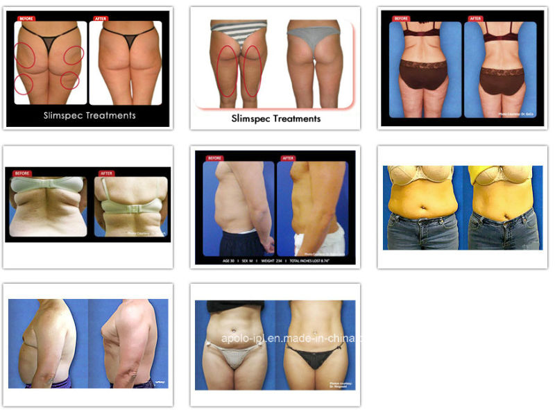 Weight Loss/ Lipo Laser/Slimming Lipo Laser Machine