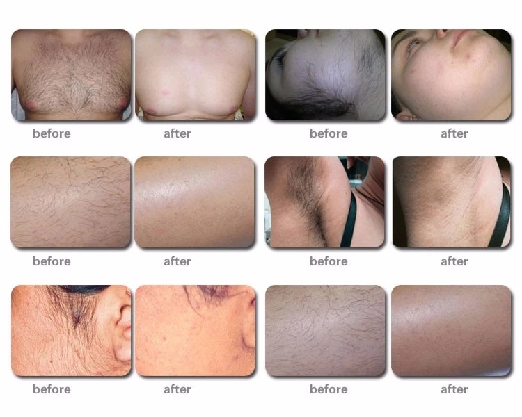 Professional Laser Hair Removal Beauty Machine Shr IPL