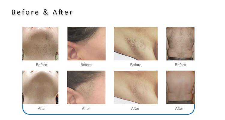 2021 Hotest Diode Laser Hair Removal/ 755nm &808nm&1064nm Diode Laser Hair Removal