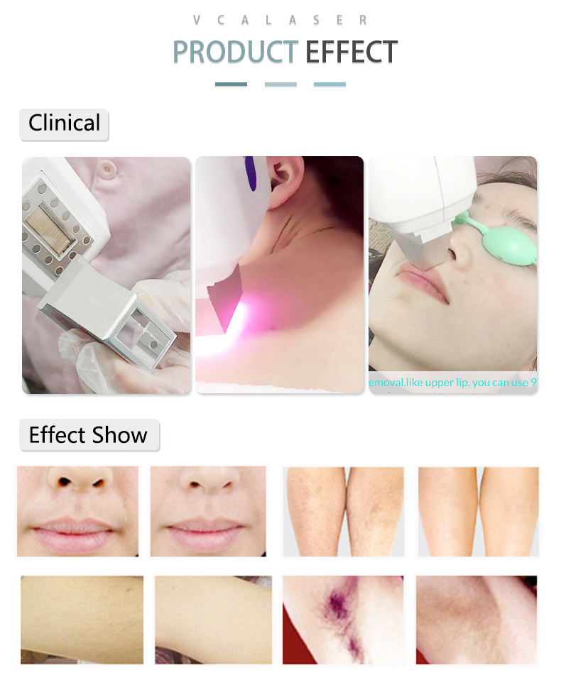 High Output Power 808nm Diode Laser Hair Removal