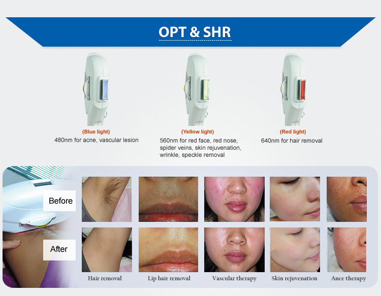 Portable Multifunctional Machine Ce Approved Factory Shr /Opt/ IPL+ Elight +Laser Multifunctional