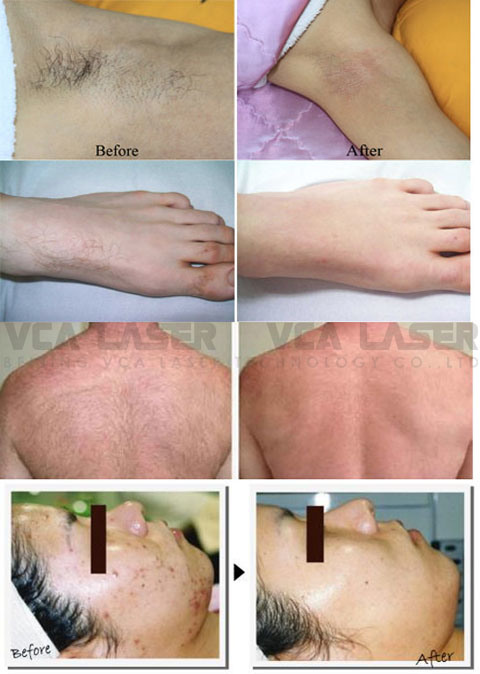 Beijing Vca Professional Hair Removal and Skin Rejuvenation Shr Laser Machine