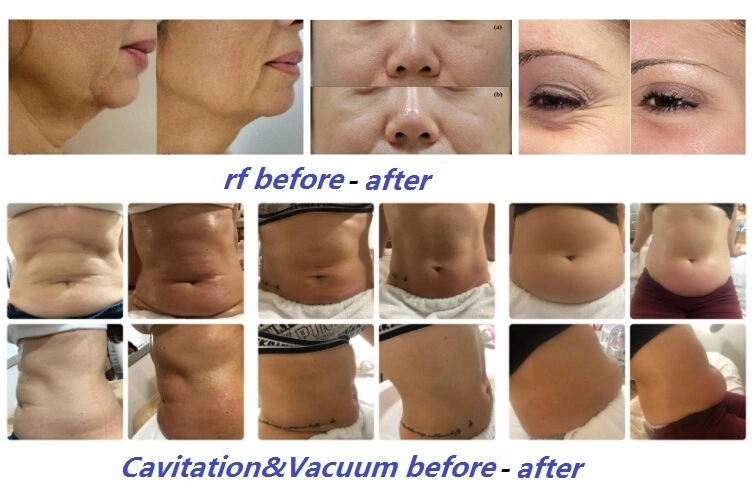 Cavitation RF Vacuum Slimming/Ultrasonic Cavitation/Slimming Cavitation Machine for Sale