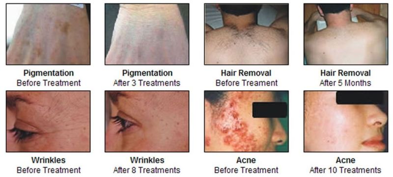 Hot Sell Shr Laser IPL, IPL Machine, Shr IPL Hair Removal Skin Rejuvenation