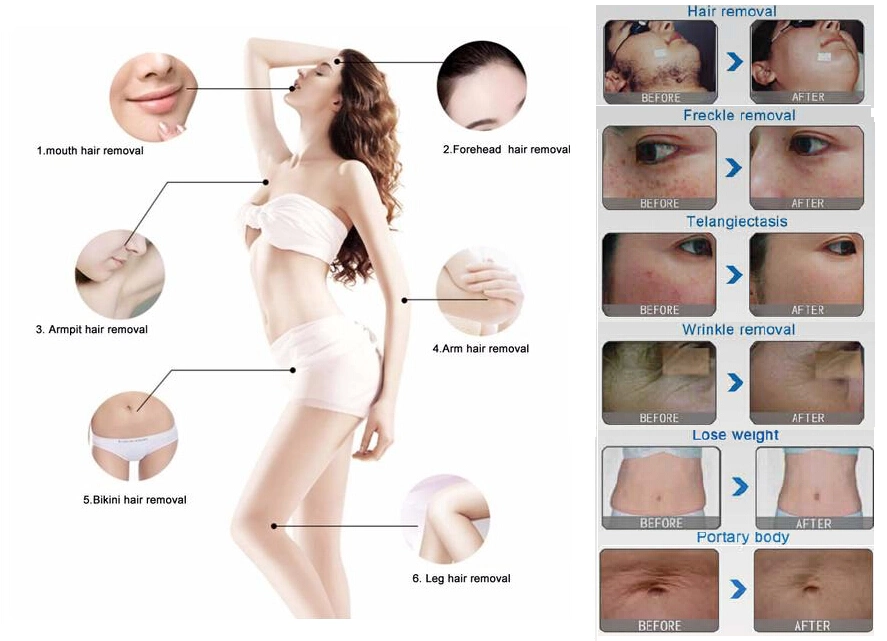 Multifunction Beauty Machine (IPL+RF+elight + cavitation)