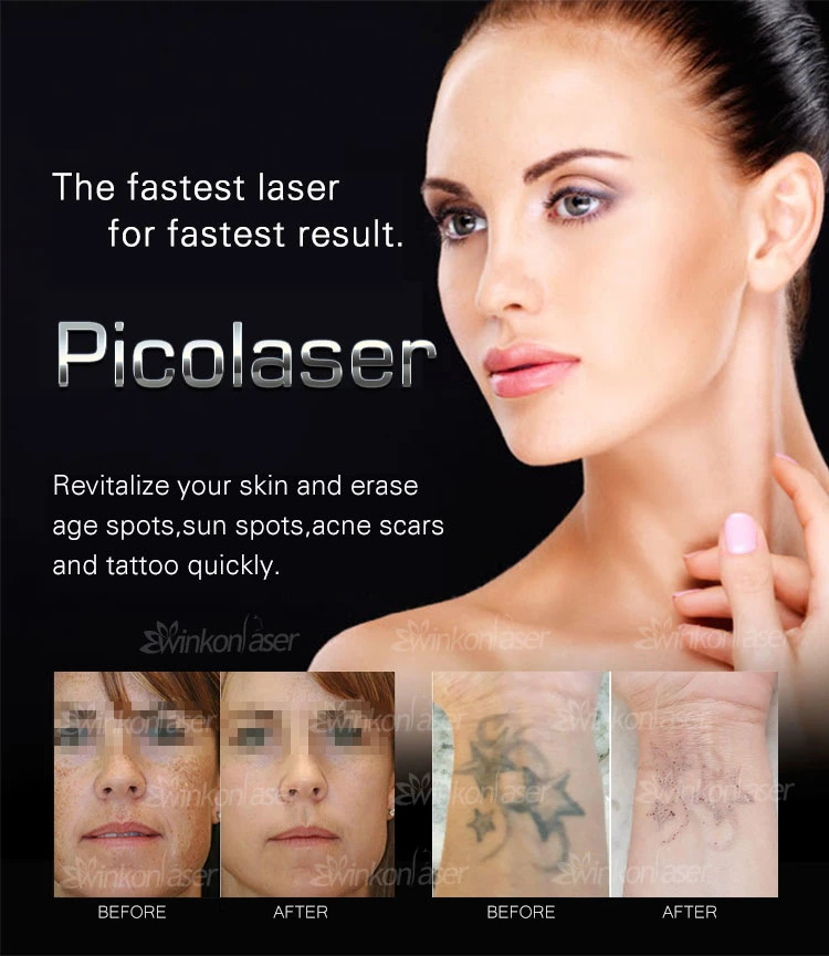 Korea Imported ND YAG Laser Arm Pigment Tattoo Removal Pico Machine Price 755nm Picosecond Laser