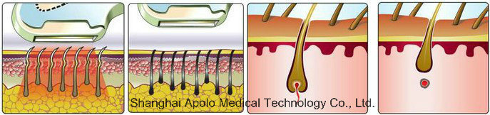 Hair Removal Beauty Skin Opt Shr IPL Hair Loss Machine / IPL Epilator Instrument