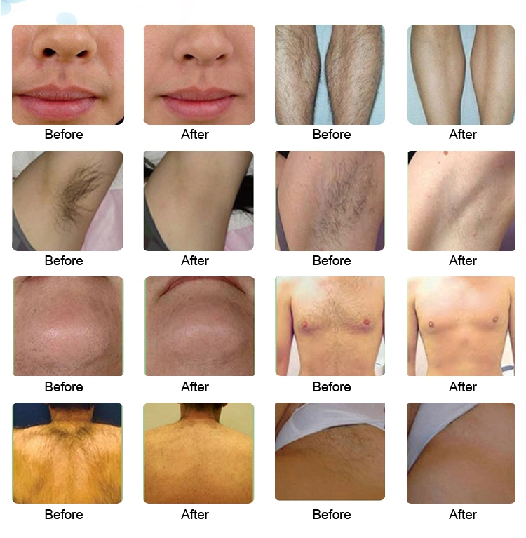 Advanced Technique Fast Machine Diode 3 Combined Wavelengths 755 810 1064nm Laser Hair Removal