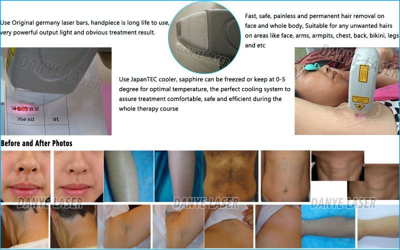 Factory Sale Laser Hair Removal Diodo 755 808 1064 Laser 3 Waves Rejuvenescimento Pele