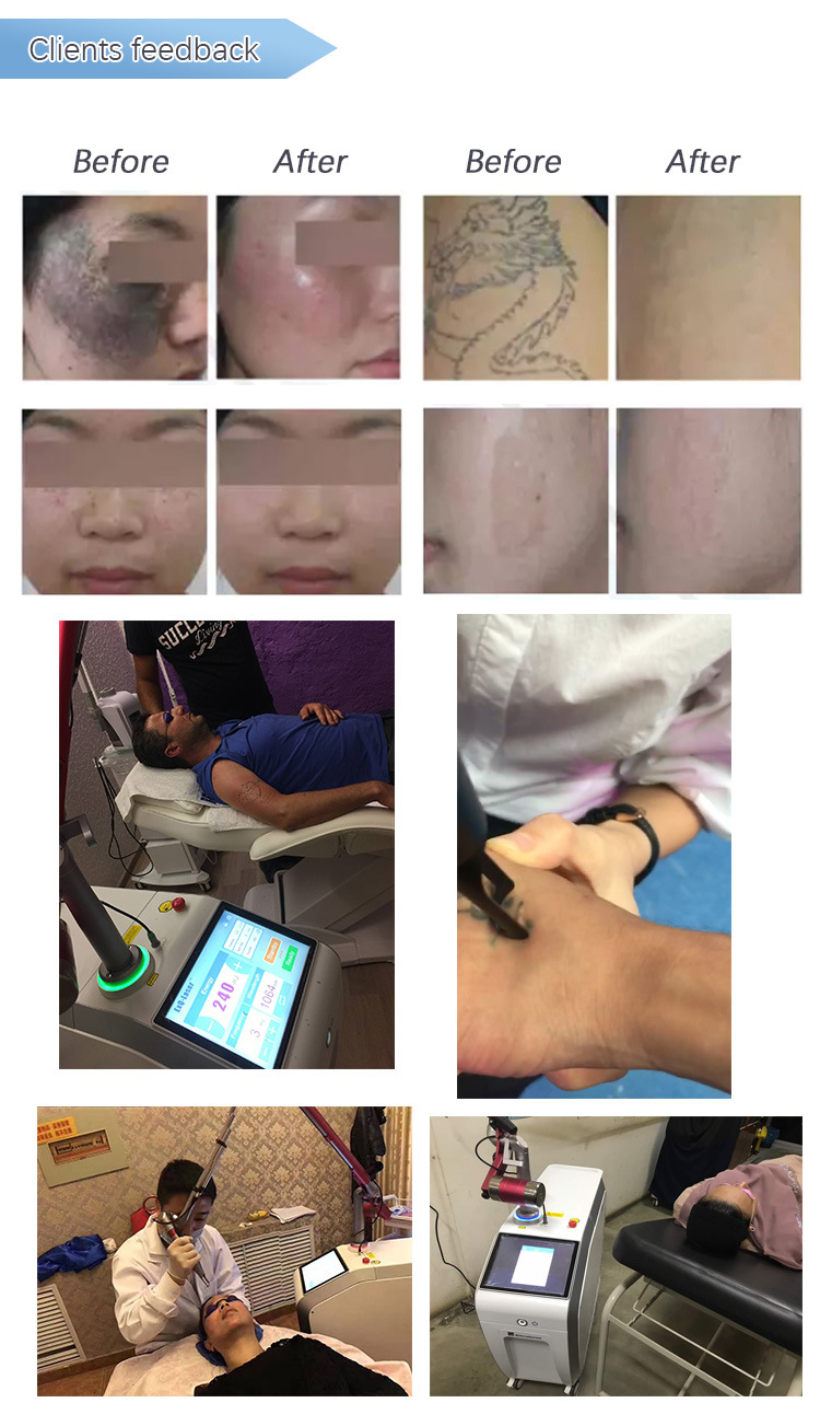 Q Switch ND YAG/Tattoo Removal Machine/ND YAG Laser Tattoo Removal