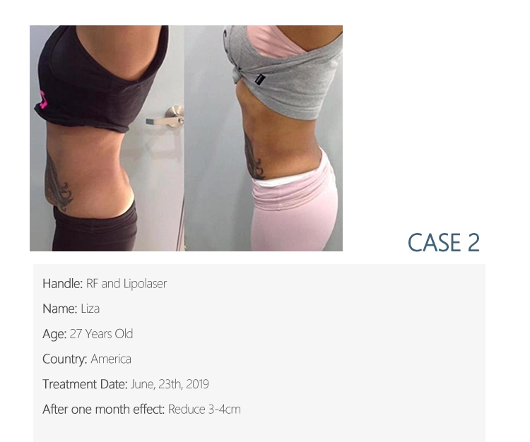 Nuovo design Kryolipolysis perdita di peso corpo dimagrimento perdita di peso Kryolipolysis Macchina in vendita