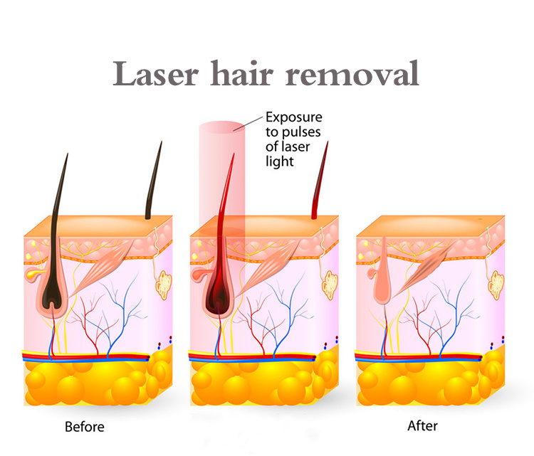 Laser Hair Removal Machine 808nm Diode 808 Nm Diode Laser